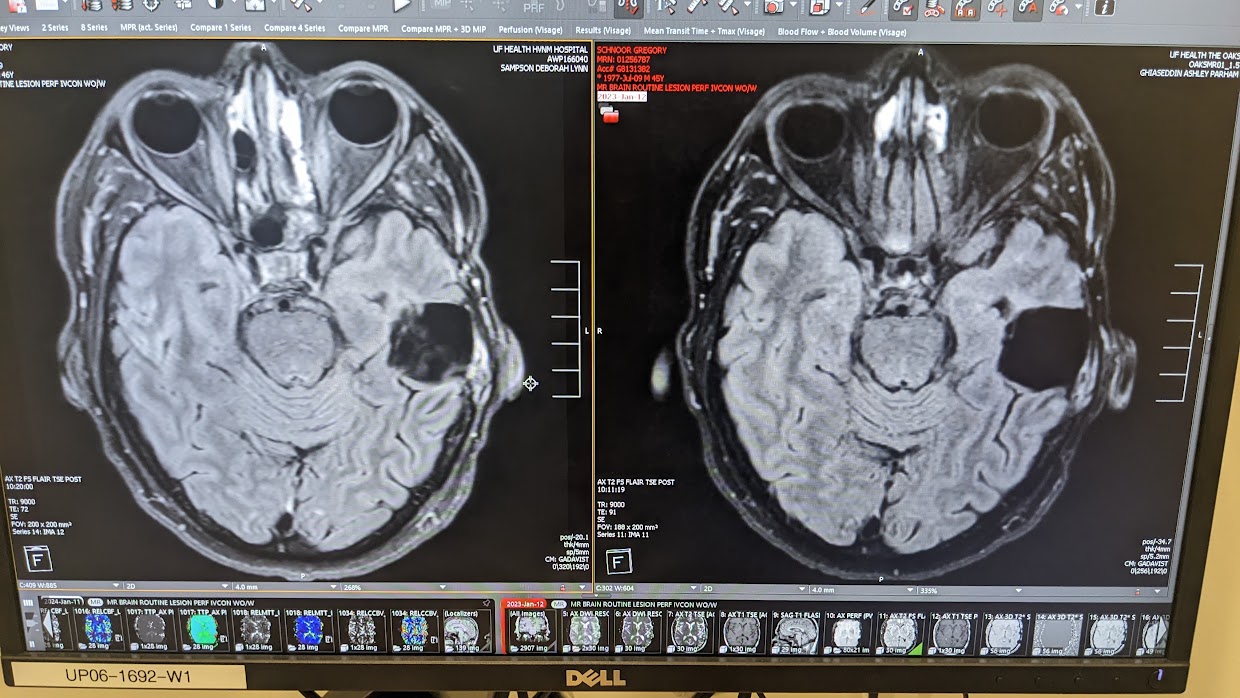 Brain Cancer Journey