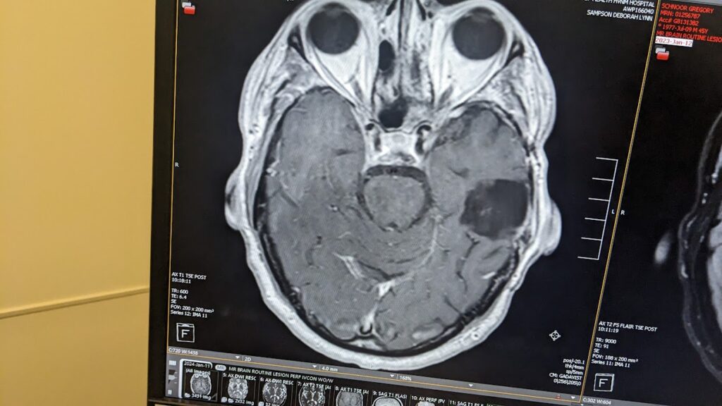 How a Sinus Surgery Led to My Brain Tumor Diagnosis — and Saved My Life