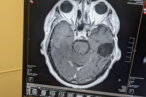 How a Sinus Surgery Led to My Brain Tumor Diagnosis — and Saved My Life